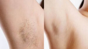 Epilation laser : avant/après - Dr Isabelle Baratte - Dermatologie esthétique, correctrice laser, Lyon